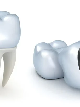 When Do You Need a Dental Crown? Signs You Shouldn’t Ignore